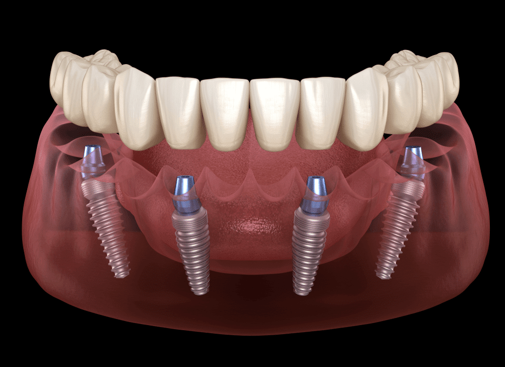 Dental implants. 