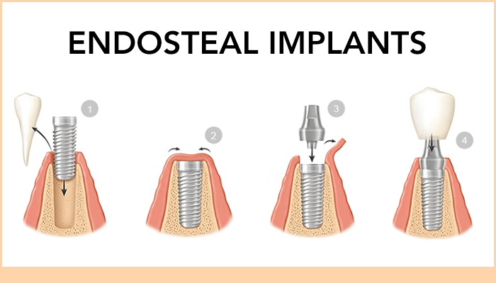 Endosteal Dental Implants