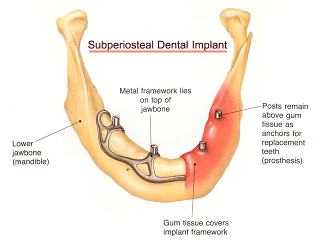 Subperiosteal Dental Implants