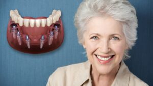 Dental Implants in Mexico