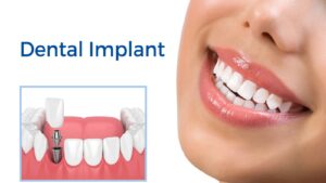Dental Implants in Tijuana - Dental Image
