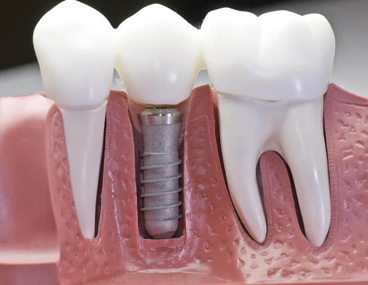 Dental Implants in Tijuana
