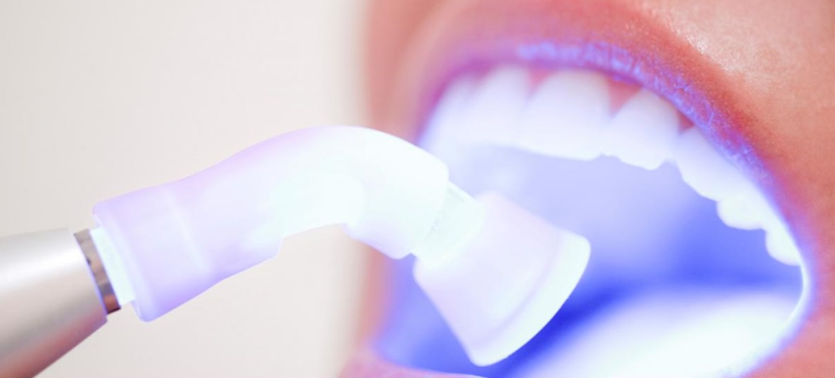 Whitening treatment in Mexico | Dental Image