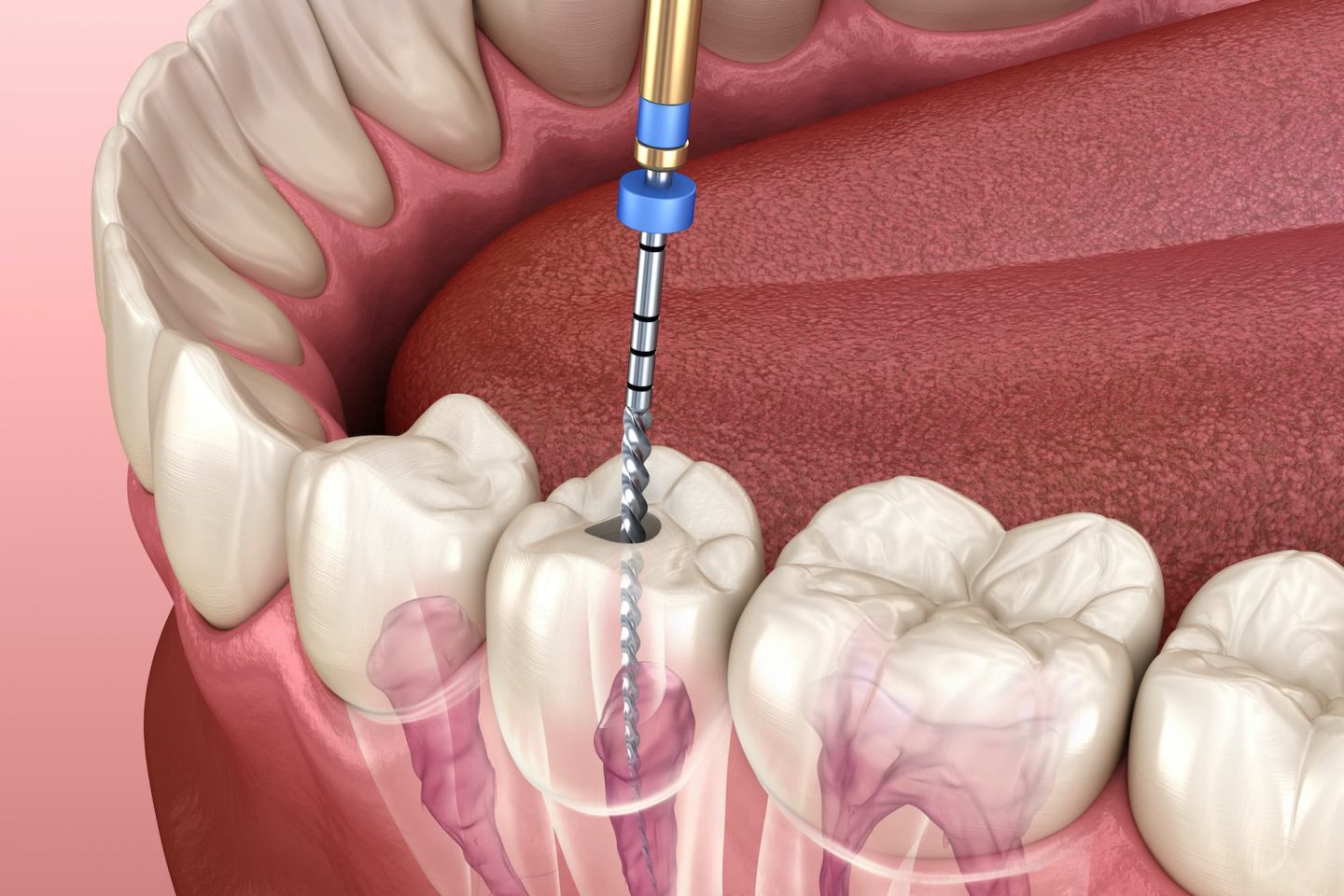 Root Canal in Mexico | Dental Image