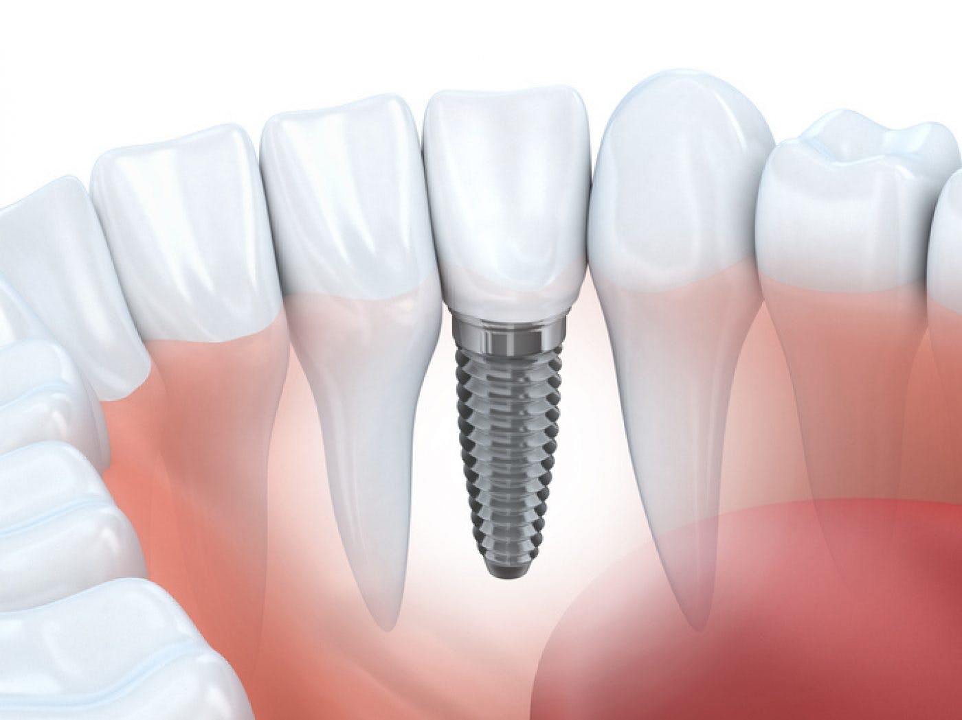 Single Implant in Mexico | Dental Image