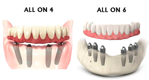 all-on-4 dental implants san diego