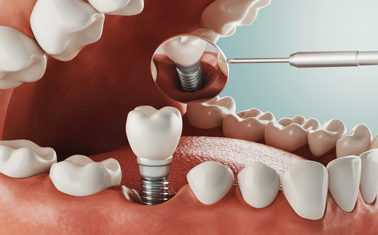 dental implants san diego cost 