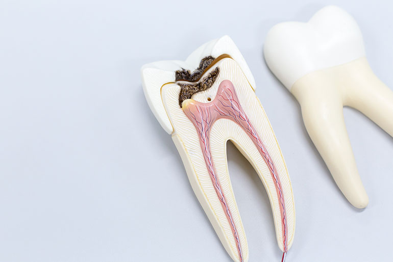 how much does a root canal cost in tijuana