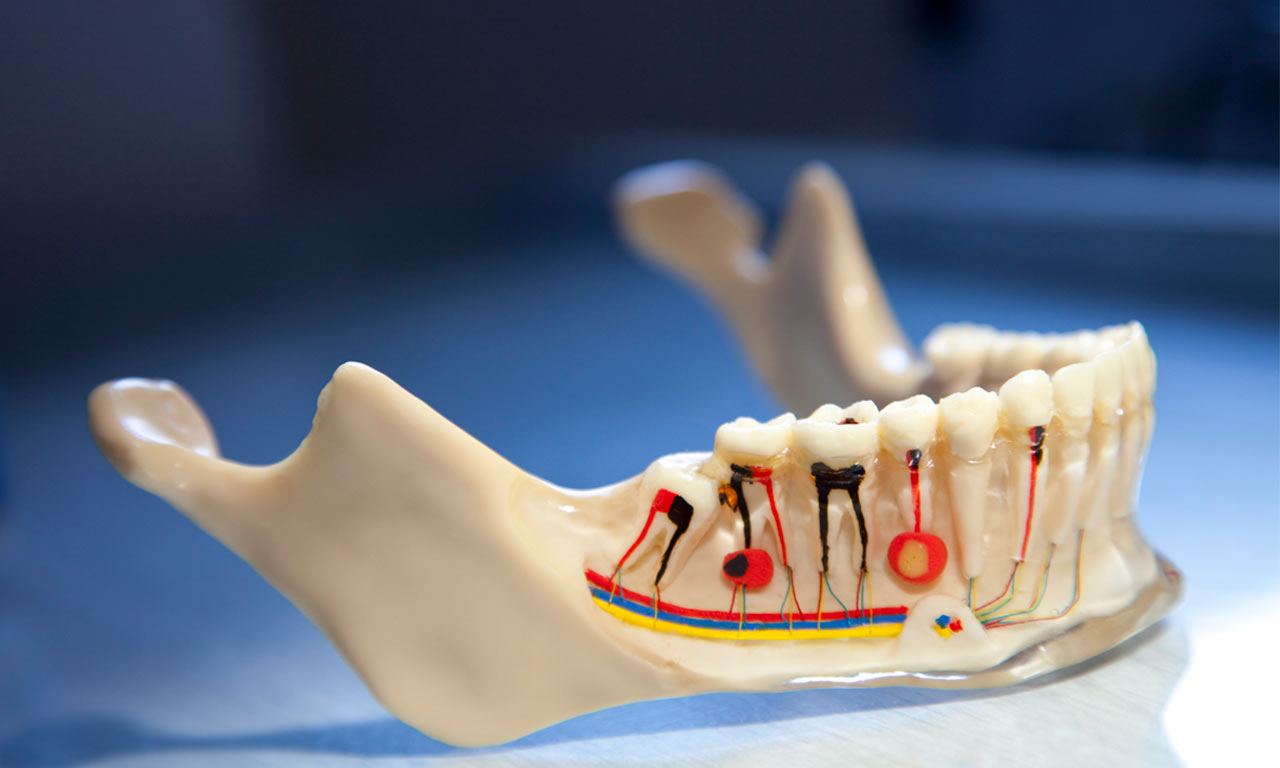 how much is a root canal and crown in tijuana