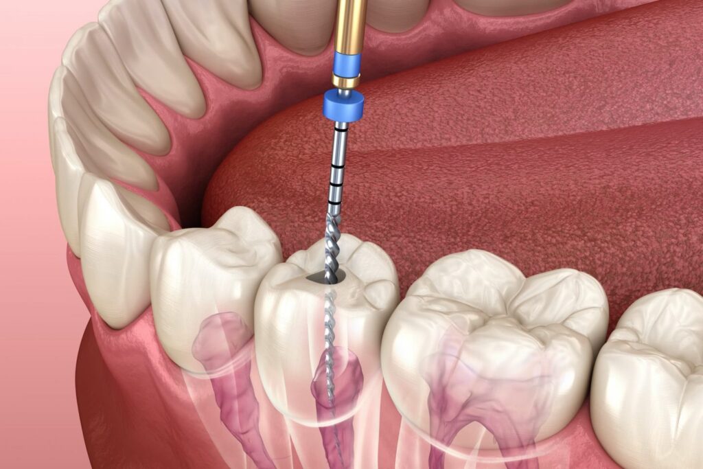 root canal and crown cost in tijuana