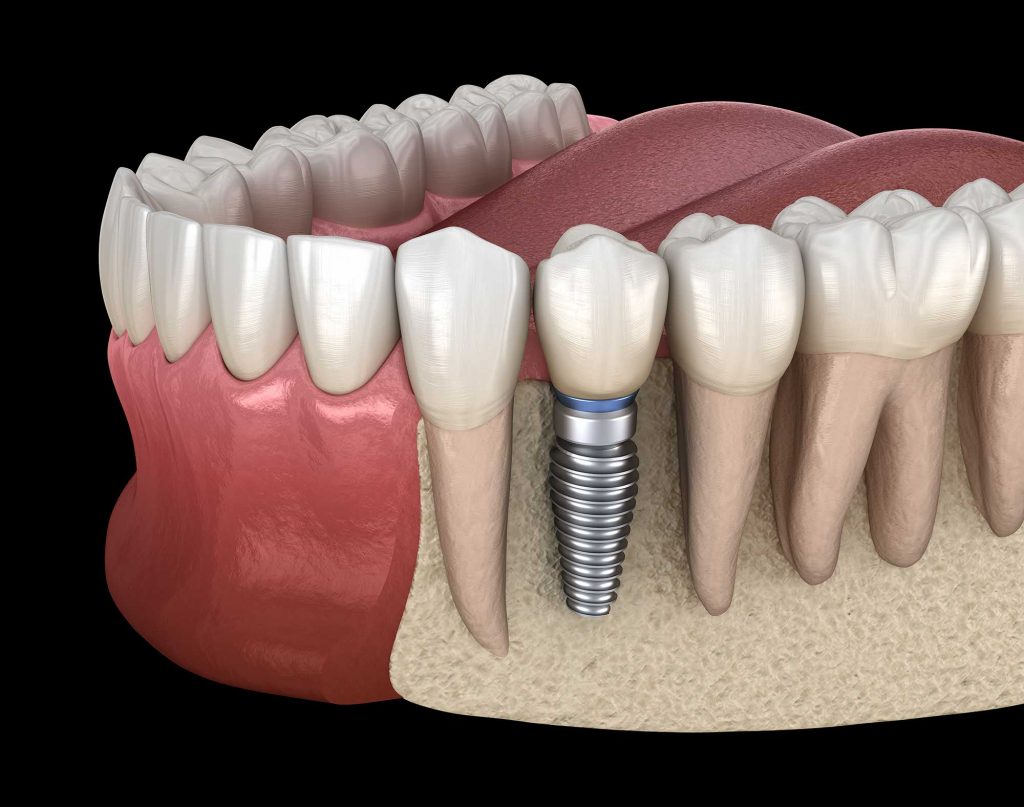 implante dental precio tijuana