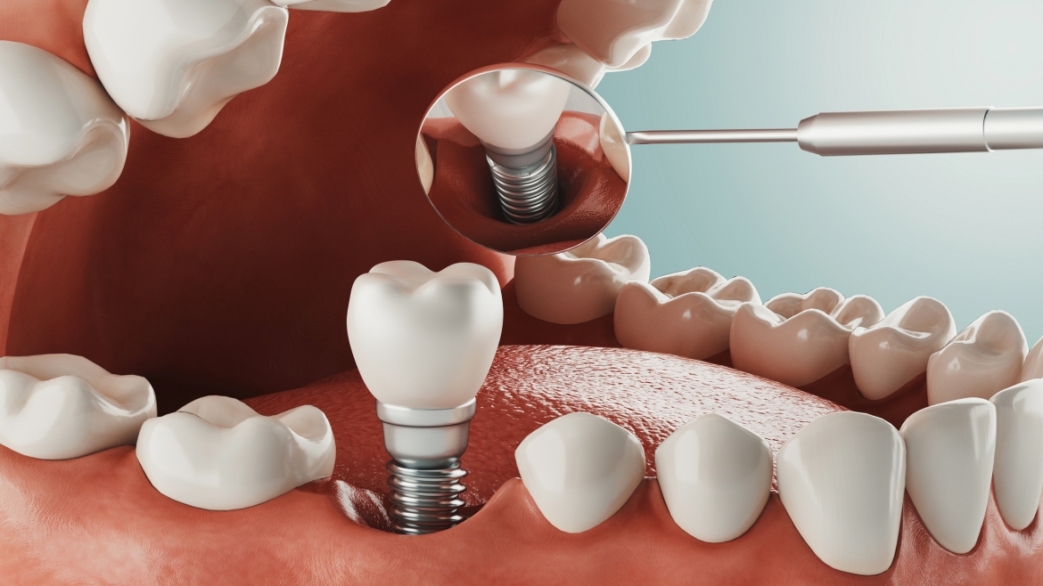 implante de diente en tijuana