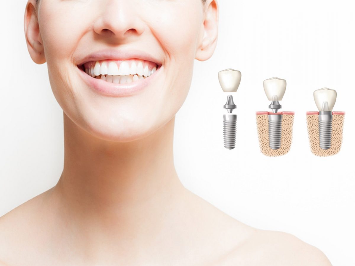 implantes dentales tijuana