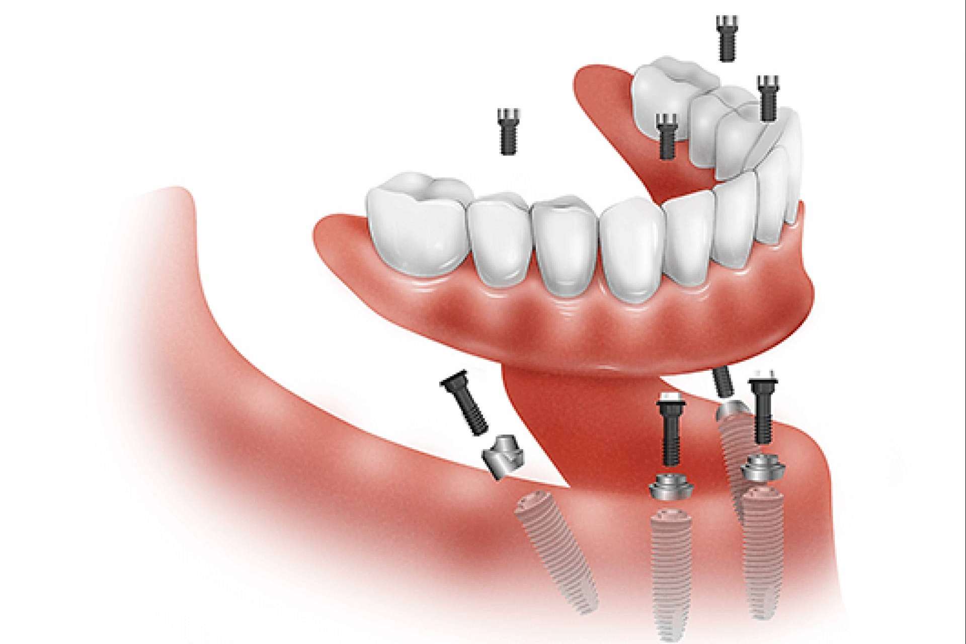 how many trips do i need for dental implants in mexico