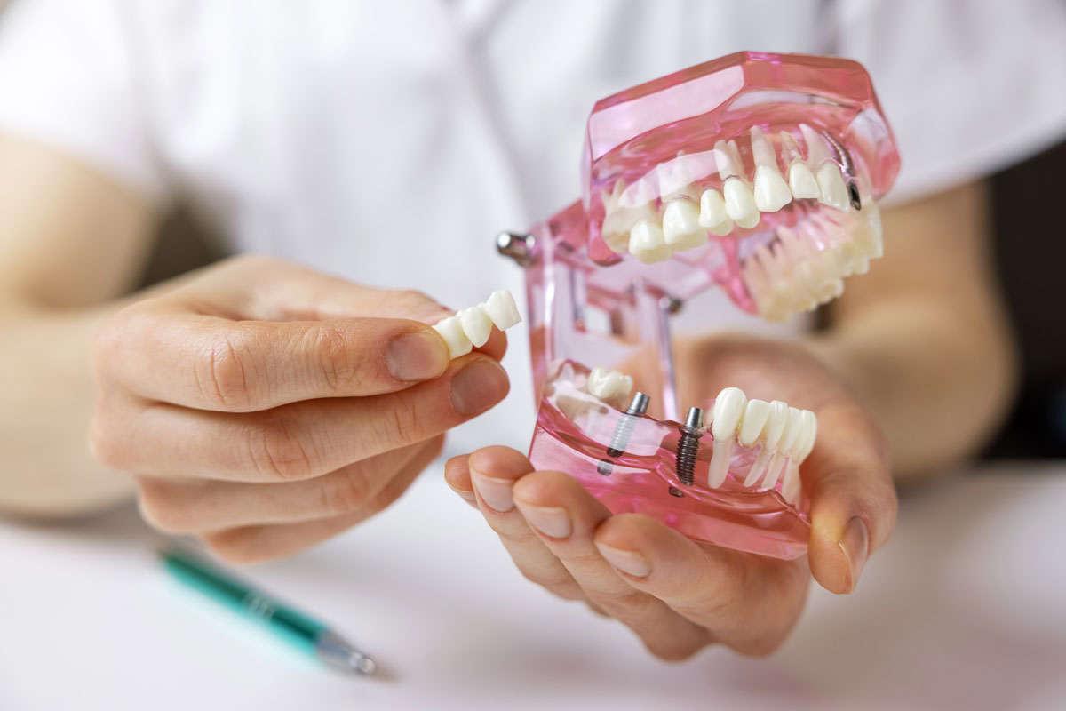 implante de diente en tijuana
