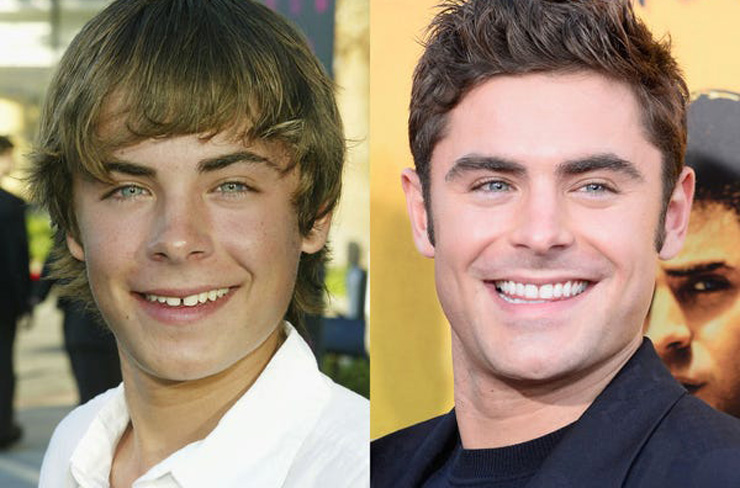 celebrities before and after veneers