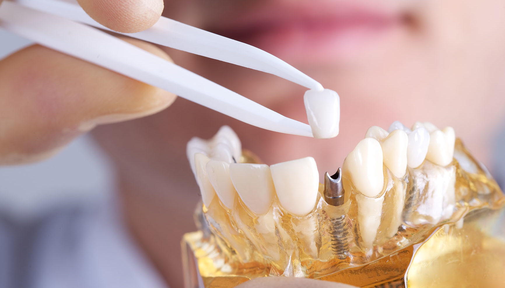 implantes dentales méxico vs US
