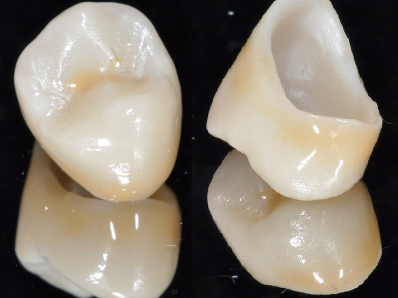 corona de diente de zirconia