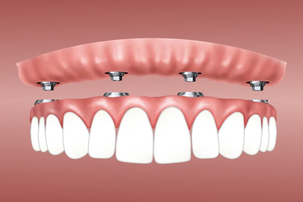 dentadura fija sobre 4 implantes precio