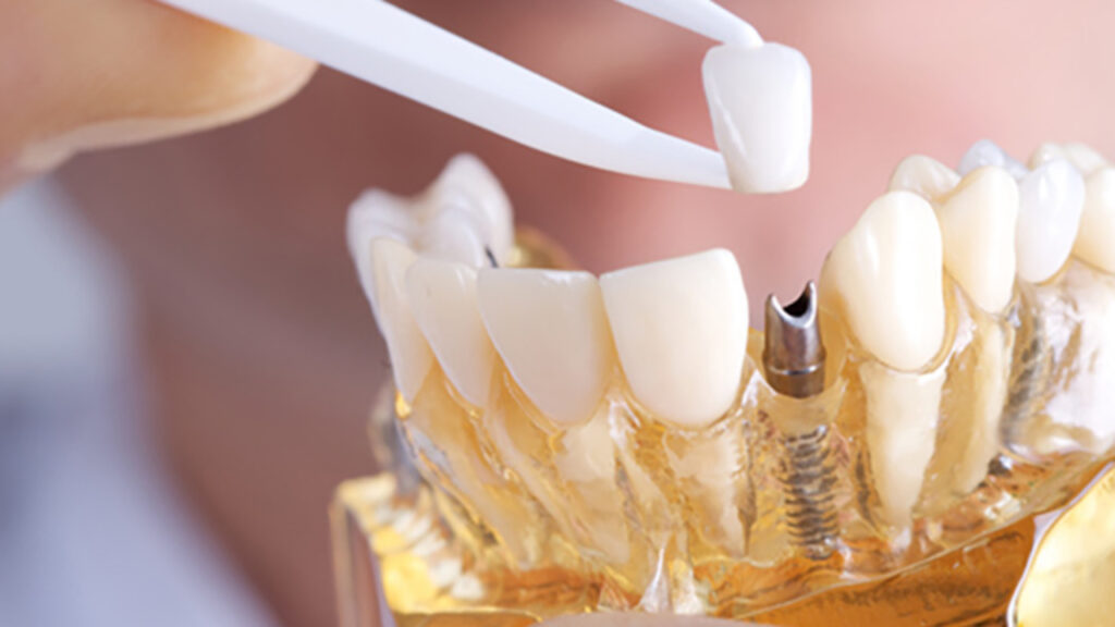 cuanto cuesta un implante dental en mexico
