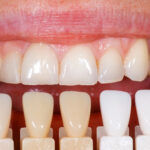 what are the most natural looking veneers