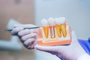 is it safe to get dental implants in tijuana mexico